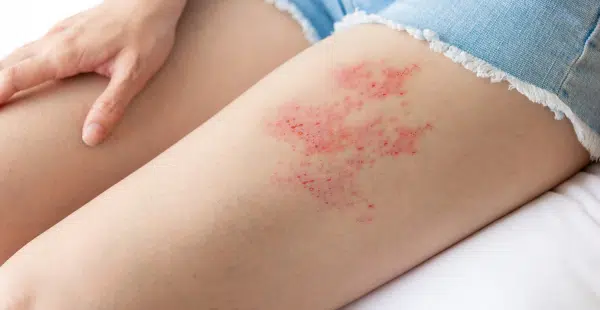 ВНИМАНИЕ: Ето коя е причината за това рядко кожно заболяване... 7 shingles zona.png